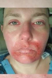 Apenas alguns segundos no sol são suficientes para causar queimaduras na pele de Emily Apenas alguns segundos no sol são suficientes para causar queimaduras na pele de Emily