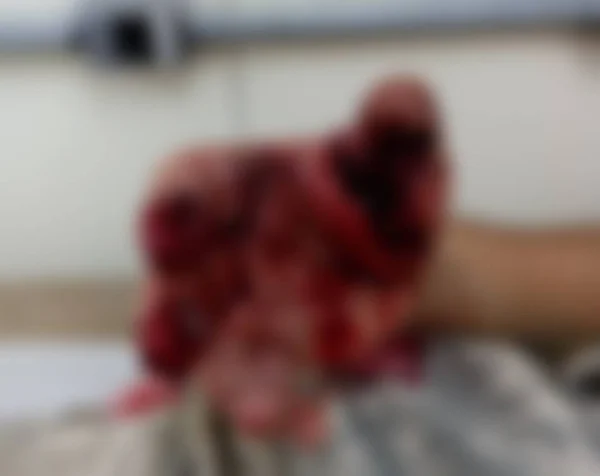 Homem tem mão dilacerada ao pegar bomba achando que era rastreador