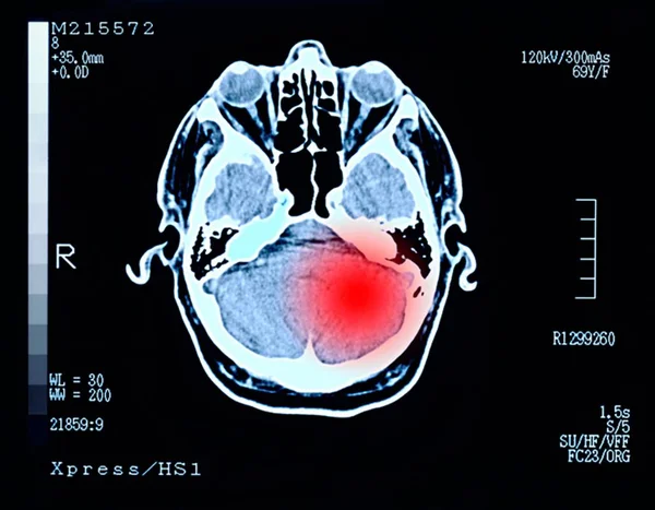 Tomografia apontando sinal vermelho no cerebro do paciente