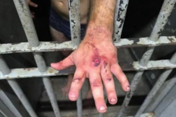 Foto mostra as marcas dessa agressão cruel e brutal pode ser vista nas mãos de Igor Eduardo que atacou a ex com 61 socos