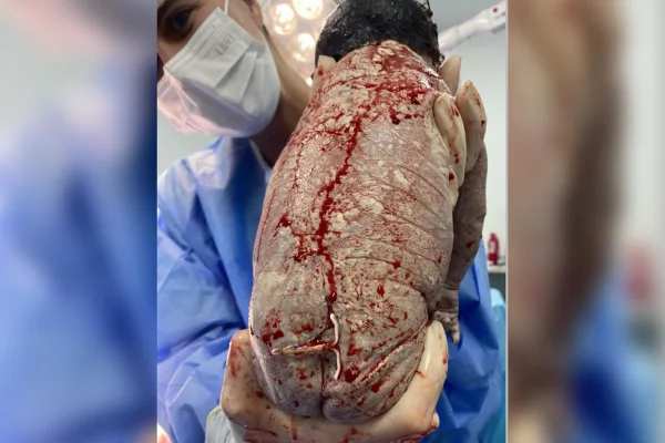 Foto do bebê Bernardo com o DIU da mãe colado no bumbum. Metrópoles