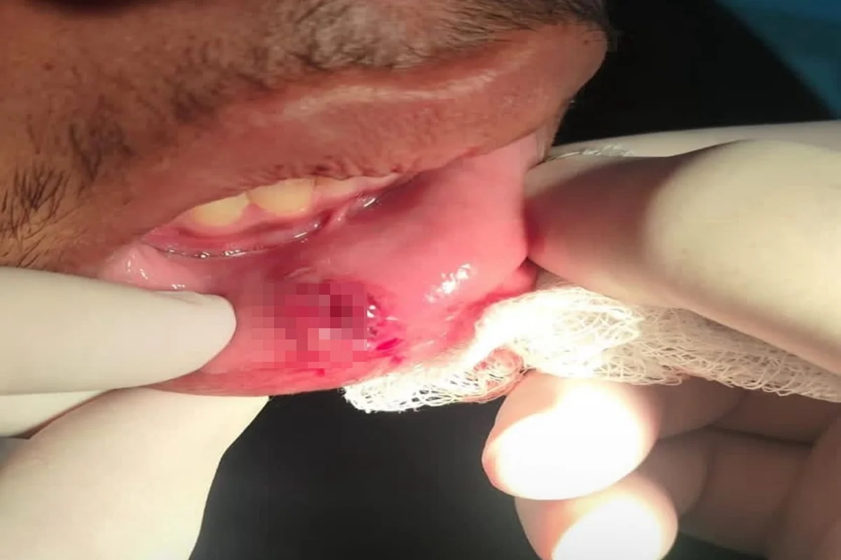 Dente quebrado e pisão na cabeça: trio agride e ameaça adolescentes 2 Boca machucada