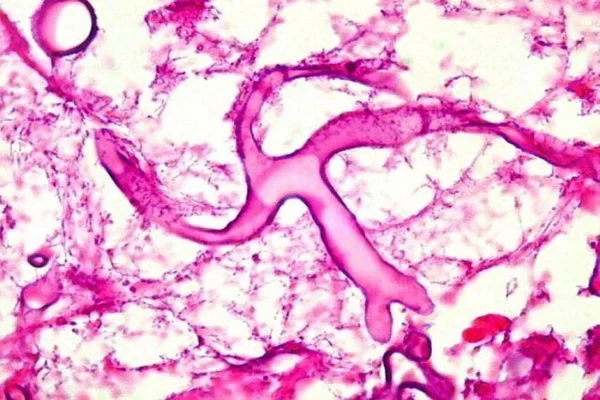 Mucormicose: óbito por “fungo preto” é investigado em Manaus