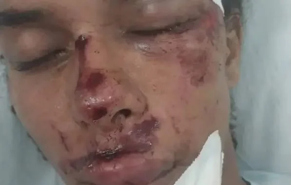Imagem colorida de influenciador com marcas de agressão no rosto - Metrópoles