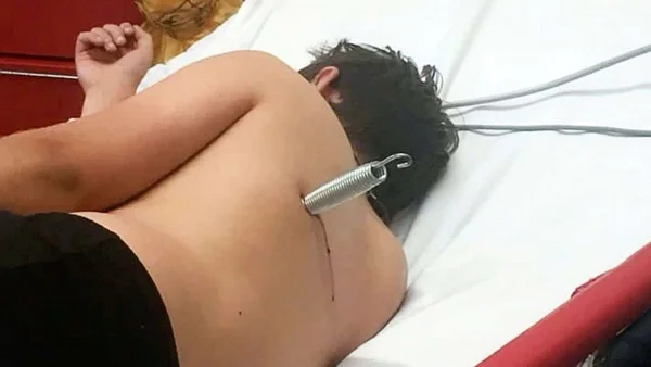 Criança sofre acidente em pula-pula e fica com mola cravada nas costas