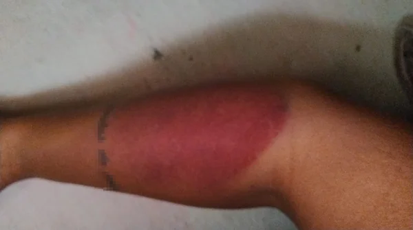 braço com hematoma