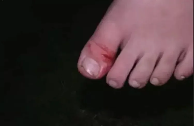 Pé do menino após o acidente Pé do menino após o acidente