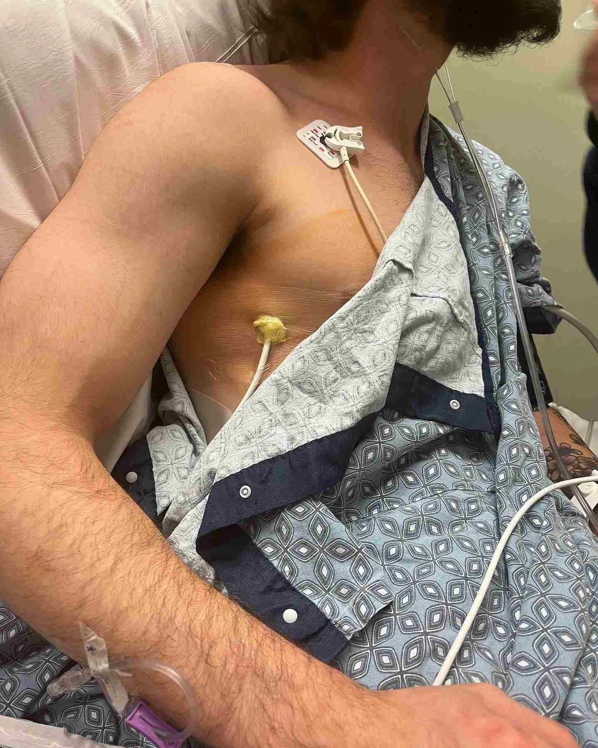 Jovem ainda está em recuperação após retirada de parte do órgão Jovem ainda está em recuperação após retirada de parte do órgão