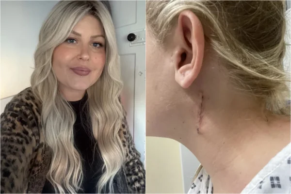 Duas fotos coloridas de mulher loira sorrindo e de perfil com cicatriz no pescoço - Metrópoles