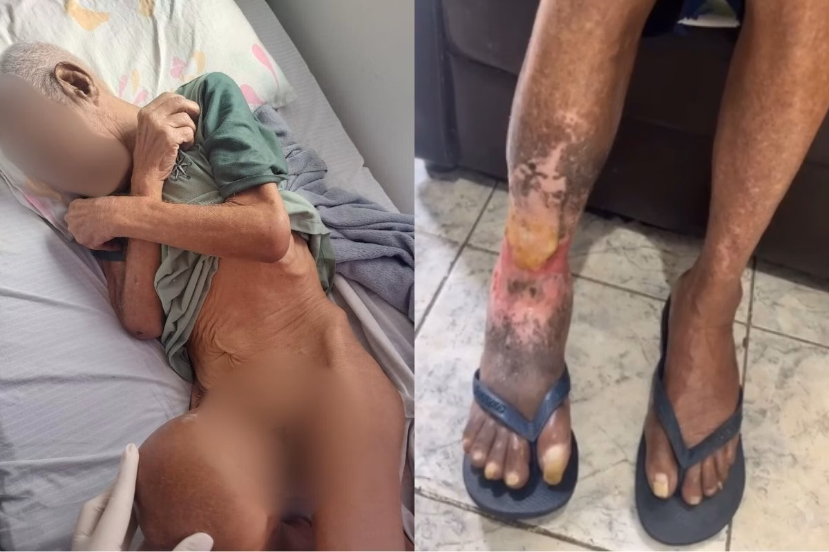 Imagem colorida mostra idoso em condições e maus-tratos em abrigo e machucado na perna de paciente. Metrópoles