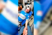 A vítima teve ferimentos no supercílio, abaixo do olho, na bochecha e na orelha, além de uma fratura facial A vítima teve ferimentos no supercílio, abaixo do olho, na bochecha e na orelha, além de uma fratura facial