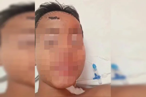 Menino de 11 anos espancado no lugar do irmão por 13 jovens tem alta