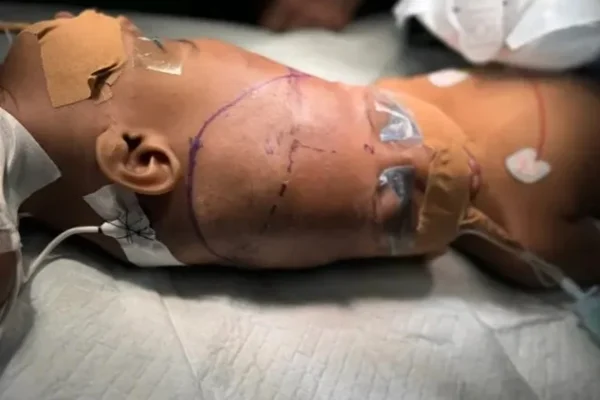 Gêmeas siamesas são separadas por cirurgia inovadora de 40 horas - destaque galeria Gêmeas siamesas são separadas por cirurgia inovadora de 40 horas - destaque galeria