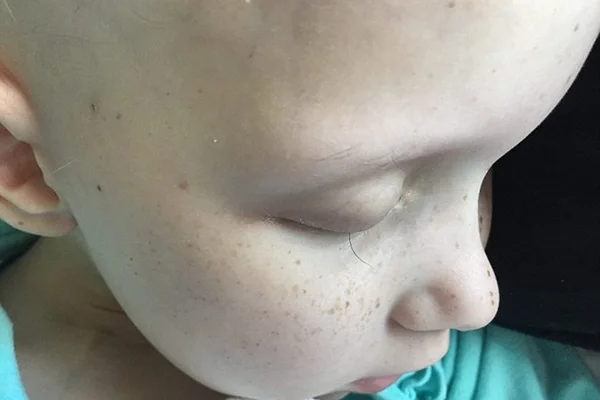 Foto do último fio dos cílios de garota que tem câncer emociona
