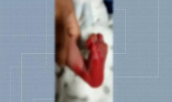 queimaduras após teste do pezinho