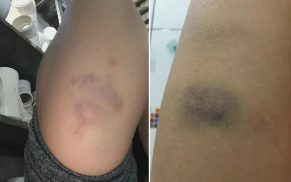 goias adolescente agride namorada hematomas