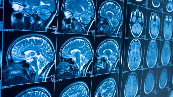 Covid leve pode causar encolhimento do cérebro, diz estudo de Oxford