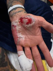 Chef Henrique Fogaça mostra lesões de acidente de moto que o afastou do MasterChef