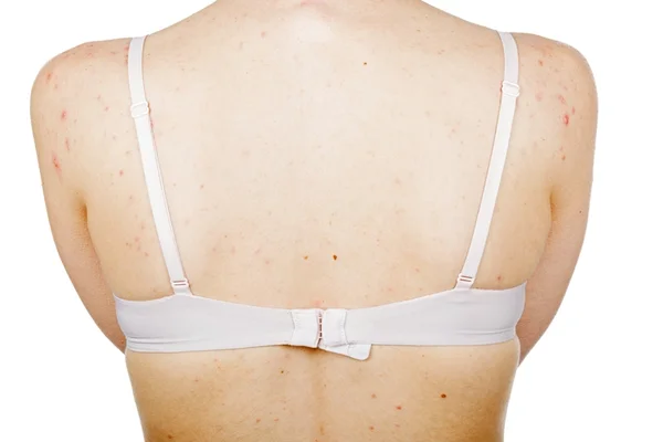 Acne nas costas: saiba mais sobre as causas e soluções