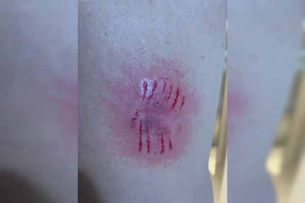 Marca de mordida de cachorro em perna de homem