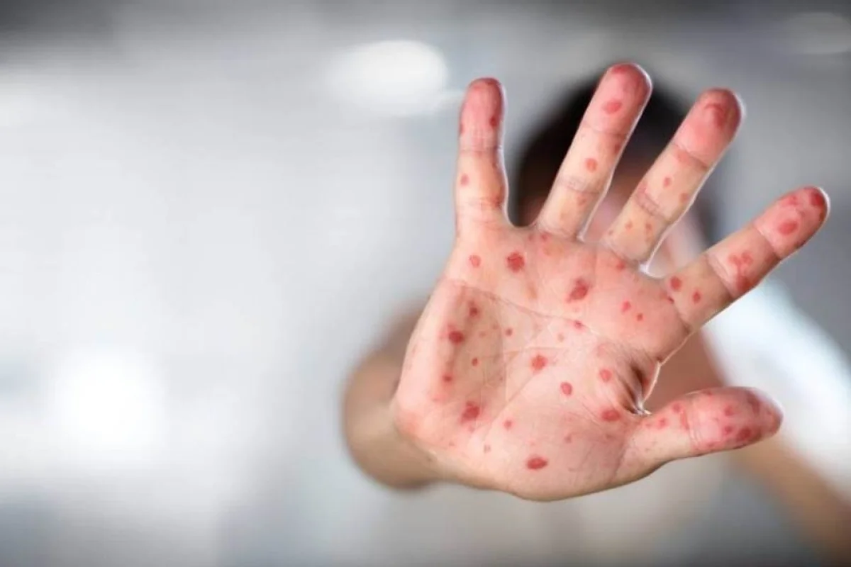 São Paulo atinge 7 casos de sarampo em 2026; SES recomenda dose zero da vacina