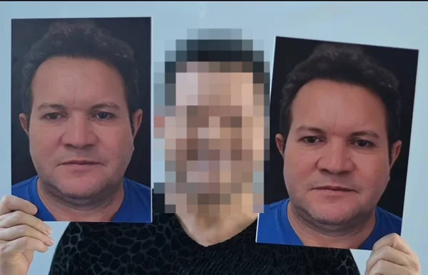 Foto colorida de Ximbinha após harmonização facial - Metrópoles