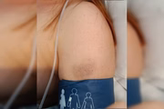 Hematomas no braço