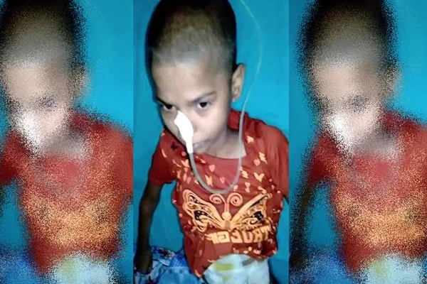 Cirurgia retira massa de cabelo de 1,4kg em estômago de adolescente