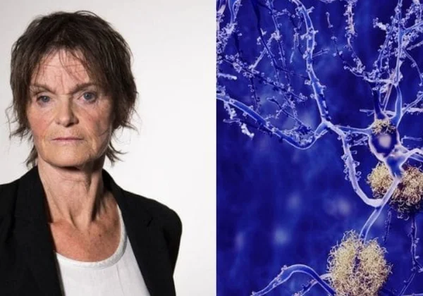 Cientista está a um passo da cura da esclerose múltipla