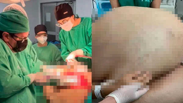 Mulher retira tumor 46 kg Rio