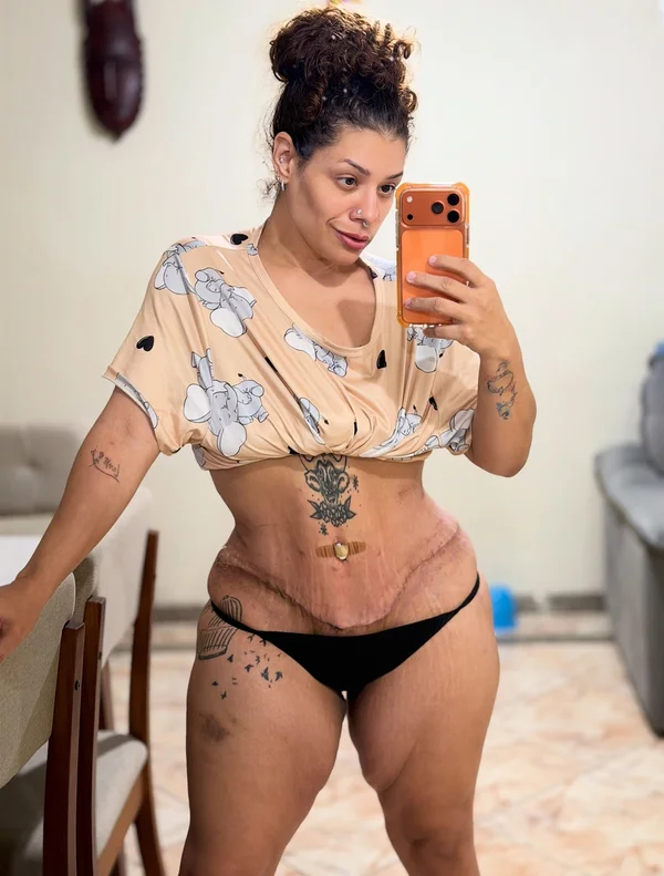 Ex-The Voice Aila Menezes mostra cicatriz após perder 90kg - destaque galeria Ex-The Voice Aila Menezes mostra cicatriz após perder 90kg - destaque galeria