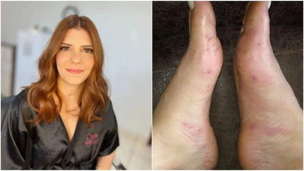 Jovem mineira tem perna amputada após pisar em espinhos