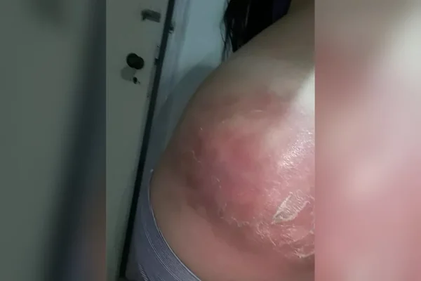 Bruna teve infecção grave na nádega após injeção de corticoide feita por UPA de Santos