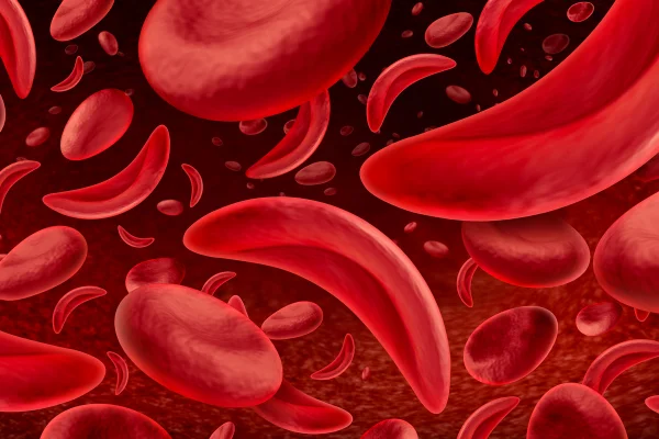 Ilustração mostra hemácias com formato de foice, como acontece na anemia falciforme - Metrópoles