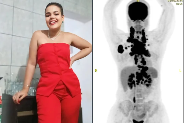 Linfoma Rafaela 24 anos (2) câncer