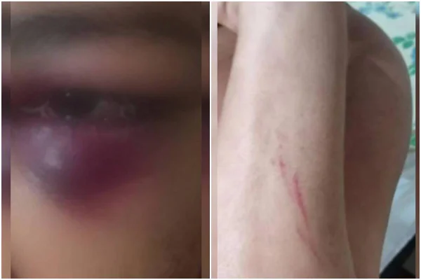 Lesões e olho roxo; mulher é agredida pelo marido por mais de 12 horas