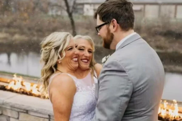 Detalhe do casamento de gêmea siamesa chama atenção; saiba qual
