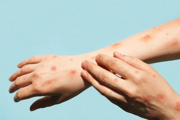 Foto de braços de homens com feridas de mpox - Metrópoles