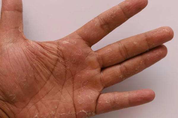 Entenda o que bolhas nos pés e nas mãos podem significar