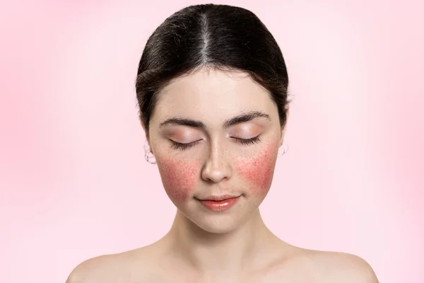 Rosácea é o novo blush? Trend transforma imperfeições em inspiração