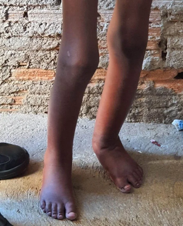 Imagem colorida mostra pernas de menino negro que era torturado pelo pai e família na cidade de Campinas em 2021 - Metrópoles