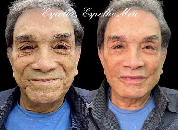 Especialista alerta sobre os riscos da harmonização de Dedé Santana