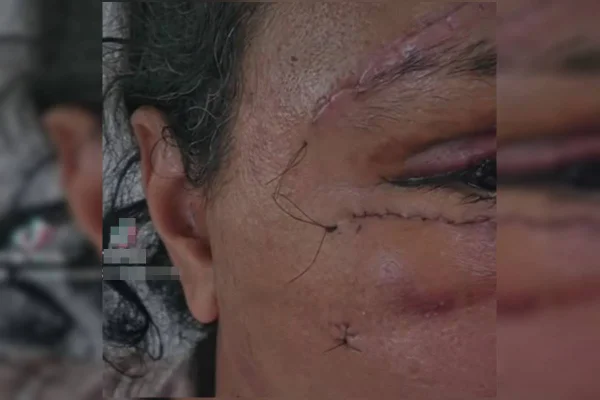 Foto colorida que mostra lesões no rosto de uma mulher agredida com 61 socos pelo ex