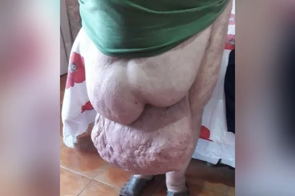 hérnia 30 kg
