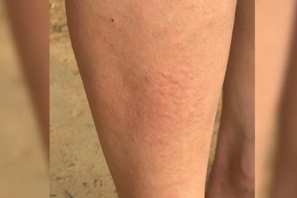 Moradores de SC usam luvas no calor contra infestação de mosquitos