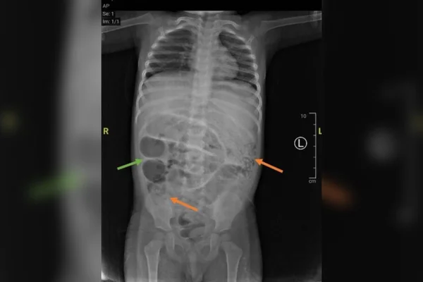 Raio-X do estômago revelou "obstruções intestinais". Metrópoles