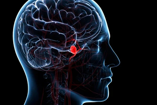 Ilustração de cérebro com aneurisma cerebral - Metrópoles