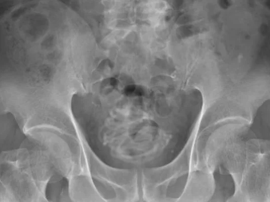 exame de imagem do objeto dentro do corpo do paciente