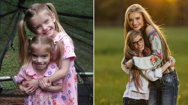 fotos de irmãs gêmeas que tem estatura e peso diferentes em dois momentos da vida: à esquerda, foto das irmãs na infância. Á direita, foto atual