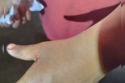 Foto da mão do menino de 3 anos que foi atingido pelo pai